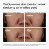 image:imageThe Ordinary AHA 30  BHA 2 Peeling Solution Advanced Exfoliating Peel for Brighter SkinAHA 30  BHA 2 Peeling Solution
